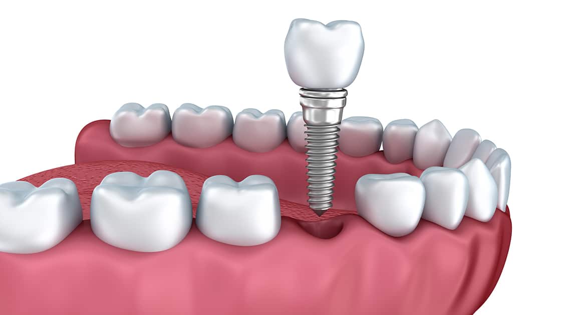 Dental Implant Restorations